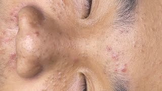 ACNE TREATMENT VU QUYNH MI  Blackheads Perennial EveryWhere Squeeze Nose 2024 [upl. by Sherm544]