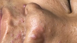 ACNE TREATMENT VU QUYNH MI  Blackheads Chin amp Nose Of Tweens 2024 [upl. by Perkin402]