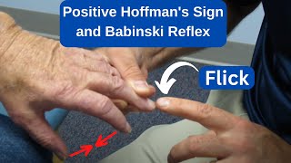 Positive Hoffmans Sign and Babinski Reflex in an MS Patient [upl. by Acilegna]