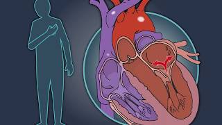 MitralValve Repair in Heart Failure [upl. by Mcleod]