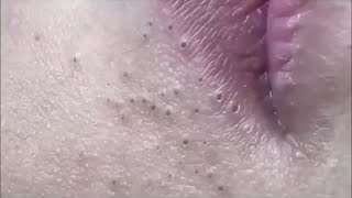 Ultimate Pimple Popping 2024 Deep Blackhead Extractions [upl. by Ardnaskela694]