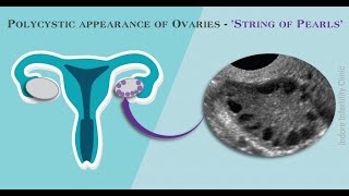 Polycystic Ovaries PCOD  PCOS  How they appear on Ultrasound  Sonography  String of Pearl [upl. by Andria]