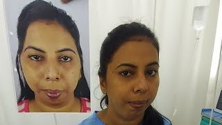 Amazing Face Transformation surgery Before amp After  Live [upl. by Morly]