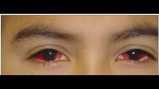 Pediatric Ophthalmology Lecture Preview [upl. by Aeneas]