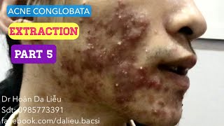 Mụn trứng cá mạch lươn nặngDermatologistpimpleswhiteheadacne conglobata extraction befor 7ws aft [upl. by Noeled725]