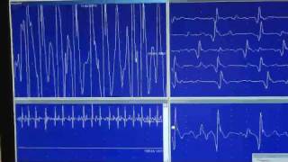 EMG JVC Patrón neurógeno [upl. by Aynahs774]