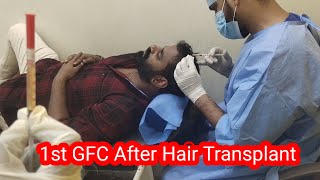 1st GFC After Hair Transplant in HSN Hair Transplant Clinic in BangaloreTamil Hair Transplant [upl. by Roch]