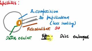 OPTIC NEURITIS  Ophthalmology  3 [upl. by Adnyc649]