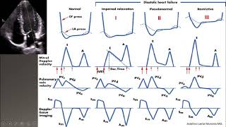 diastolic dysfunction part IIgrading ASE 2016 [upl. by Hajidak]