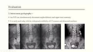 Urolithiasis [upl. by Shedd]