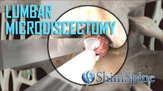 Lumbar Microdiscectomy [upl. by Gladdy65]