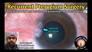 CataractCoach 1038 recurrent pterygium surgery [upl. by Langdon]