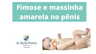 Fimose e massinha amarela no pênis [upl. by Didi]