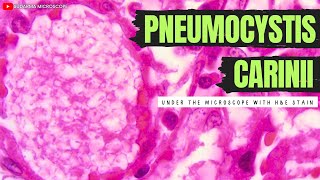 Pneumocystis carinii under the microscope with Haematoxylin and Eosin HampE stain [upl. by Leslie]