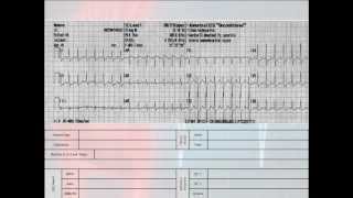 12 Lead Interpretation Part 62 EKG Changes and Lead Localization of Myocardial Infarctions [upl. by Hyacinthia]