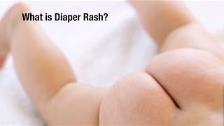 How do I Treat Diaper Rash  Everything You need to Know about Diaper Rash [upl. by Mellicent885]