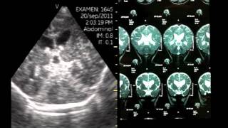 VSCAN Pocket Ultrasound Transfontanelar Hydrocephalus Hidrocefalia [upl. by Argela]