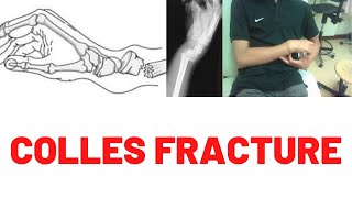 COLLES FRACTURE Distal Radius Fracture XrayReductionSymptoms CausesSigns Colles vs Smiths [upl. by Nnyroc883]