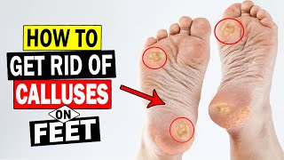 How to Remove Calluses on Feet at Home  Home Remedies for Calluses on Feet Removal [upl. by Sito]