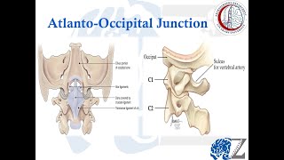 Spine Trauma 2  Atlantooccipital dislocation إصابات العمود الفقري [upl. by Ahsinrac]