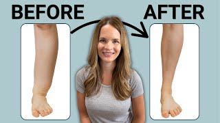 The Best Leg Lymphedema Treatment [upl. by Groveman112]