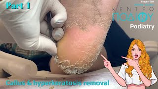 Callus amp hyperkeratosis removal 1Αφαίρεση κάλων amp υπερκερατώσεωνΚέντρο Ποδιού PodiatryPodiatrist [upl. by O'Donoghue]