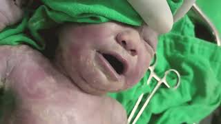 Cleen Vernix Caseosa  Cord cutting  how to cleen vernix caseosa  newborn care [upl. by Rego927]