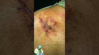 Paraumbilical hernia Repair  Umbilicoplasty shorts education [upl. by Horbal250]