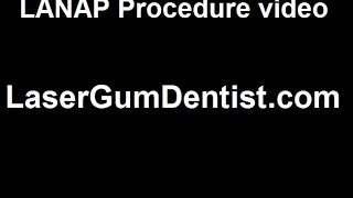 LANAP Failure Invisalign before and after periodontal Surgery GTR [upl. by Simmons]