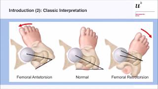 M Tannast In amp outtoeing a reliable diagnostic sign for femoral malversion Hip Symposium 2018 [upl. by Ute]