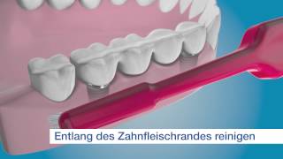 TePe ImplantatOrthodontiebürste  für die Reinigung der Außenflächen des Implantats [upl. by Normandy650]