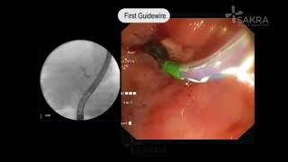 ERCP Procedure Video  Best Gastroenterologist in Bangalore  Dr Dinesh Kini  Sakra World Hospital [upl. by Helgeson]