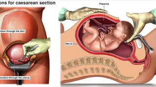 சிசேரியன் விளக்கம்  CESAREAN SECTION IN TAMIL [upl. by Schaffer]