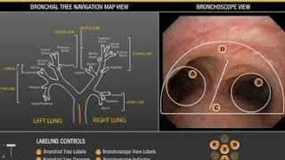 CT Virtual bronchoscopy of chest [upl. by Yuhas]