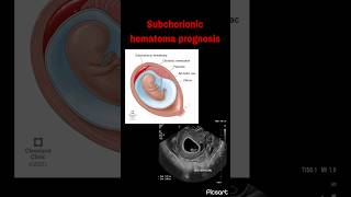 Subchorionic hematoma prognosis  Miscarriage rate following vaginal bleeding in pregnancy [upl. by Macegan]