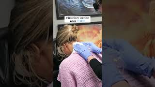 Removing All Of My Tattoos Tattoo Removal Before and After 🤍 tattooremoval [upl. by Wulfe]