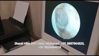 Perforated Eardrum Examination  Shanti Vilas ENT Clinic Prayagraj Allahabad By Dr AK Shukla MS EN [upl. by Sucramd180]