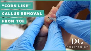 quotCorn likequot callus removal from toe [upl. by Hadias]