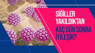 Siğil Yaktırma Nedir Siğil Yaktırma Nasıl Yapılır Her Siğil Yakılır Mı [upl. by Apthorp]