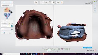 Trios 4 Upper and Lower Scans with Centric Tray [upl. by Ihcehcu]