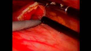 Laparoscopic gastric bezoar removal  UCSF Jonathan Carter MD [upl. by Llehcnom324]