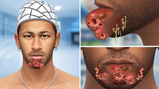 ASMR Removes Worms Pustules Maggots on Chin amp Blackheads  Deep Cleaning Animation [upl. by Pacheco189]