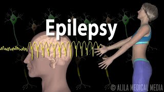 Epilepsy Types of seizures Symptoms Pathophysiology Causes and Treatments Animation [upl. by Linden238]