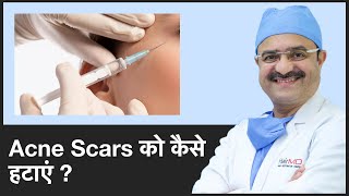 Acne Scars को कैसे हटाएं How To Remove Acne Scars  ClearSkin Pune  In HINDI [upl. by Nina]