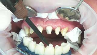 Procedure of Placing Dental Veneers Hollywood smile [upl. by Anaehr]