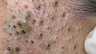 Big Cystic Acne Blackheads Extraction Blackheads amp Milia Whiteheads Removal Pimple Popping  8272 [upl. by Bakemeier344]