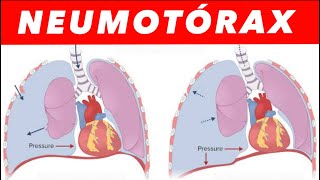 DESCOMPRESIÓN URGENTE 💉Caso clínico real‼️😱🫁 [upl. by Balthazar]