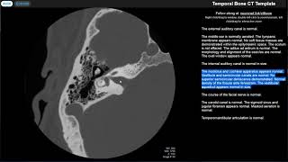 Radiology Walkthroughs  CT Temporal Bone Anatomy [upl. by Llehcor931]