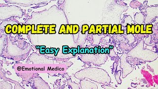 Complete and Partial mole  Differences  Reproductive Pathology [upl. by Gonzalez791]