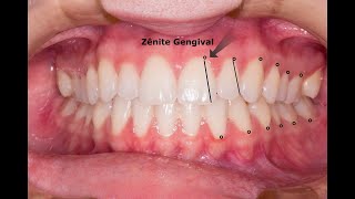 Aula de Anatomia Gengival para Ceroplastia [upl. by Anrahc]